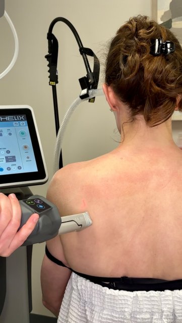 Summer is coming… and it’s not just about your face ☀️✨
If you’re wearing backless dresses, tank tops, or anything that shows a little more skin—this is your sign to treat your shoulders, back, and hands.
Our Tetra CO2 Laser with CoolPeel™ is the gold standard for:
• smoothing fine lines + crepey skin
• reducing sun damage + discoloration
• minimizing pores
• improving overall texture + tone
The best part? You get powerful resurfacing results without the downtime of traditional CO2 lasers thanks to advanced pulse technology that avoids excess heat damage.
We love using this on areas like:
✨ shoulders
✨ upper back
✨ chest
✨ arms
✨ hands
aka anywhere you want smoother, clearer, more radiant skin before summer hits.
Spots are limited as we head into peak season—now is the time to start your treatments for that effortless, polished summer glow.
📍Book your appointment now through the link in our bio
#charlestonmedspa #summerglow #radiantskinroutine #laserresurfacing #charlestonlife